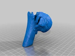 Broken humerus