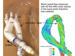 Surgically repaired coarctation of the aorta (flow model)