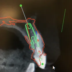 dental implant surgical guide